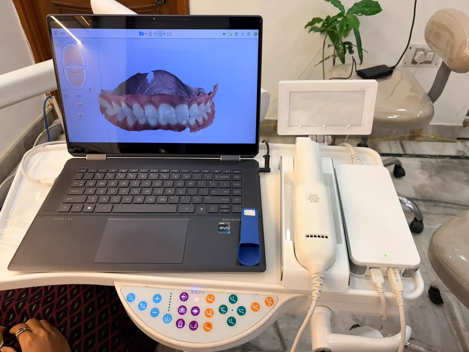 iTero Element intraoral scanner displaying a 3D scan of a patient's teeth