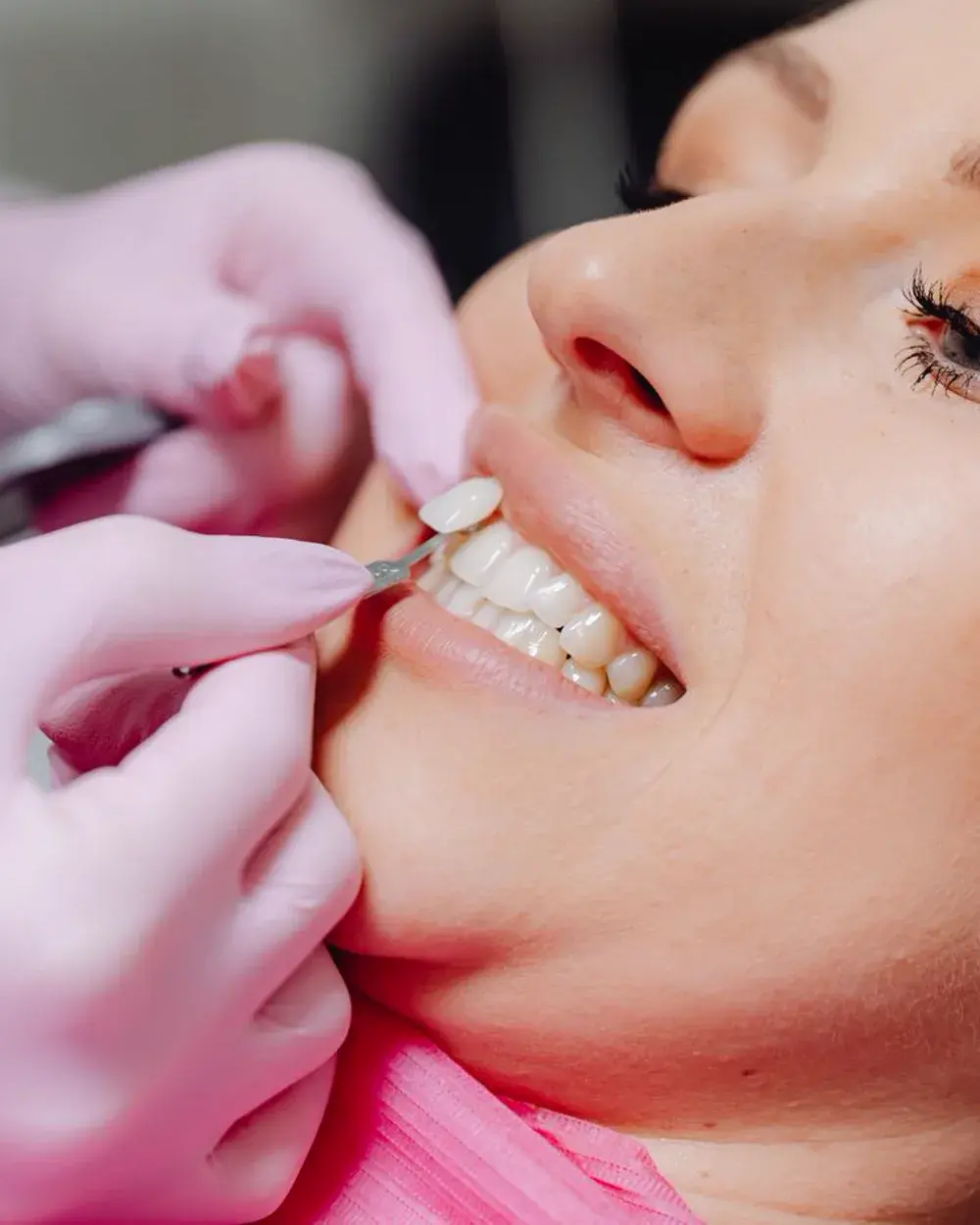 A dentist fitting a dental veneer to a front tooth